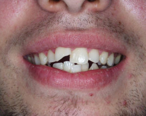 Before photo of gaps in teeth