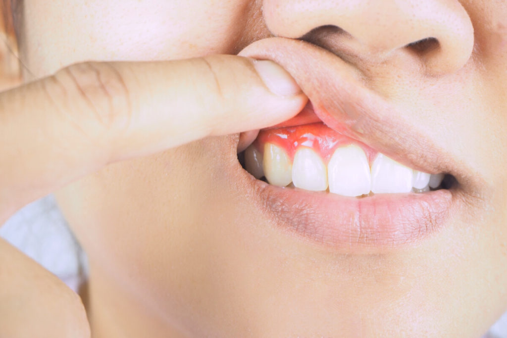 recognizing-the-5-early-signs-of-gum-disease